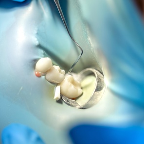 Временная пломба