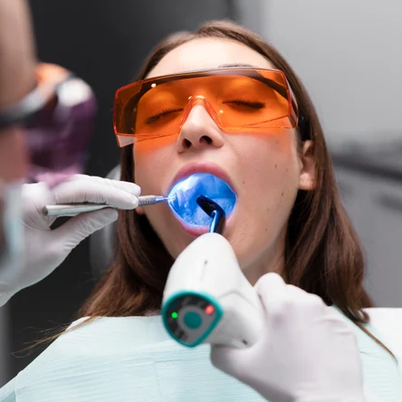 Шинирование зубов светоотверждаемым материалом в переделах 6-ти зубов