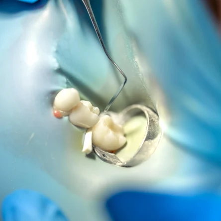 Временная пломба