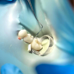 Временная пломба