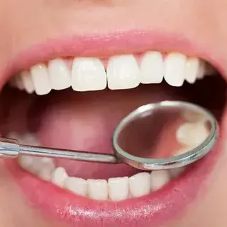 Пломба из светоотверждаемого материала